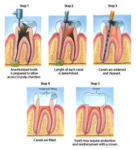 Root Canal Treatment & Crowns